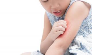 为什么有些人招蚊子